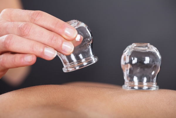 What Is Cupping Therapy?